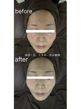 ビゼン(BIZEN)/【顔の赤みにお悩みの方】