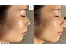 【肌管理×小顔・毛穴改善フェイシャルサロン】MavY.今福鶴見店【4/15 OPEN(予定)】/小顔♪リフトup♪