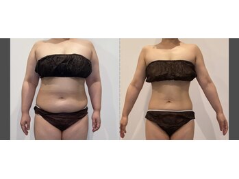 リリーパッソ(Lily passo)/痩身メニューも充実！機械もあり