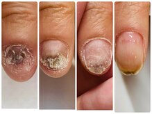 インブロッサム(imblossom)/諦めていた深刻な深爪にも対応