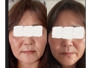 ラニモア(LaniMoa)/お悩み解決光フォト