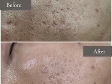 スキニティ(Skinity)/REVIハーブピーリング6回