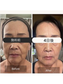 リラクゼーションサロン ラキ(laki)/ハイピールイントゥ/ピーリング