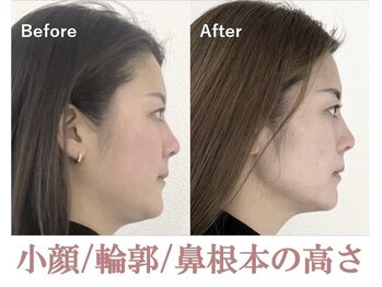 ラプリ 銀座店(Raplit)/隆鼻＋輪郭矯正40分10回