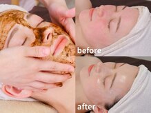 ラウレア 松山店(LAULEA)の雰囲気(毛穴・黒ずみ・ニキビ肌を整えるハーブピーリング)