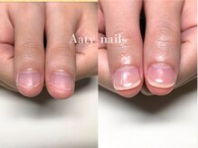 アーティネイルズ(Aaty Nails)/【深爪矯正】ハンド