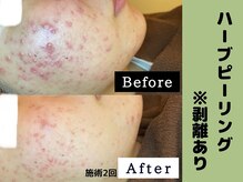 シャルムクリニカルサロン 池袋(Charme clinical salon)/ハーブピーリング※剥離あり