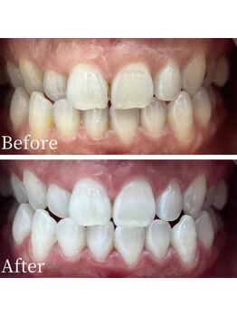 ホワイト 福岡博多店(WHITE)/ホワイトニング通い放題ビフォー