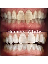 ハミーホワイト(Hammy White)/白くなりにくい歯もこの通り！