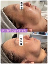 プリュネル(Prunelle)/プラズマシャワー