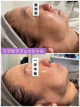 プリュネル(Prunelle)/プラズマシャワー