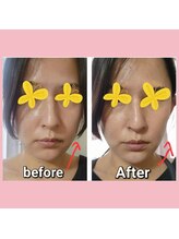 リラージェ 中目黒(Relaje)/※3回の施術効果before→After