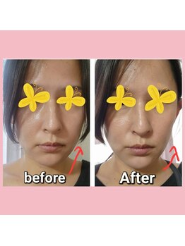 リラージェ 中目黒(Relaje)/※3回の施術効果before→After