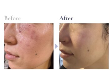 ラヴィ(Ravi)/色むら、肌の表皮の悪い癖を改善