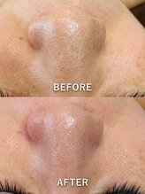 ルーク(Luke)/毛穴ケア