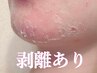 【お顔《◆ハードタイプ》ハーブ】《7日後アフターケア込》￥39000→￥35000