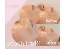 シャンス(Chance)の雰囲気(ピーチリフト 症例)