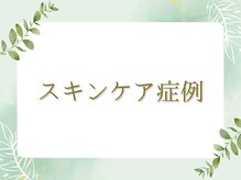 イルミナ(illumina)/スキンケアのビフォー・アフター