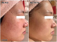 エステティックサロン みなとやの雰囲気（肌育ピーリングで美肌ケア）