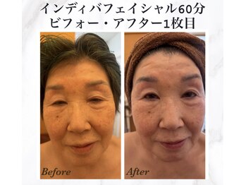 プレジール エテ(plaisir Ete)/インディバ顔60分施術前後