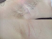 ヴィオール 名古屋栄店(VIOR)/【レディース脱毛】　脇　　