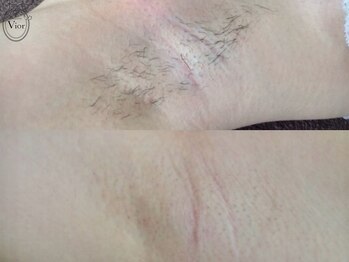 ヴィオール 名古屋栄店(VIOR)/【レディース脱毛】 脇