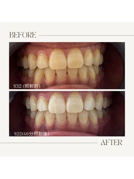 ホワイトニングビューティー 鯖江店(WHITENING BEAUTY)/初回40分照射コース