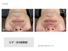 リュール(Lueur)の雰囲気（メンズ【人気NO1】ヒゲ脱毛♪）