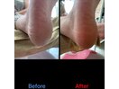 足の裏の角質メニュー