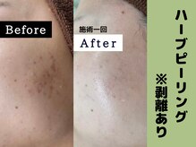 シャルムクリニカルサロン 池袋(Charme clinical salon)/ハーブピーリング※剥離あり