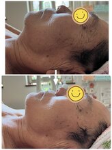 ピュア(Pure)/ハイドロフェイシャル80分