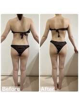 ヴィクシア(VIXIA)/ブライダル痩身