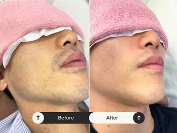 パッソ(Passo)/メンズ脱毛/若々しい綺麗な肌へ