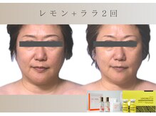 フロックス(Phlox)/レモンボトル×ララピール