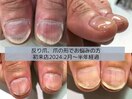 爪悩み！脱反り爪