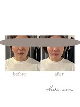 ハリムーン 仙台(harimoon)/美容鍼灸ビフォーアフター