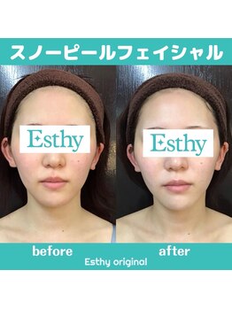 エスティービューティーサロン 南越谷店/お客様結果★ホワイト美肌ピール