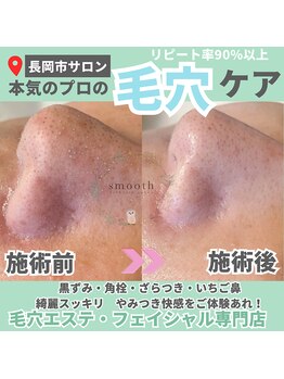 スムース(smooth)/エクソソームハーブピーリング