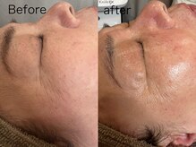 ラローゼ トウキョウ(LA ROSEE TOKYO)/シワ改善&ツヤ肌