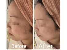 サロン ド ハニー(Salon de Honey)/国産100%ハーブピーリング