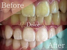 ドルチェ(Dolce)/ビフォーアフター