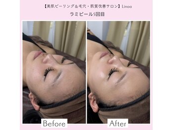 リノア 堀江(Linoa)/毛穴洗浄＆水光肌ピーリング
