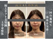 カロン(KALON)の雰囲気(むくみ顔を美容鍼で深部から根本アプローチ)