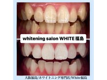 ホワイトニングサロン ホワイト(WHITE)/セルフホワイトニング/大阪/福島