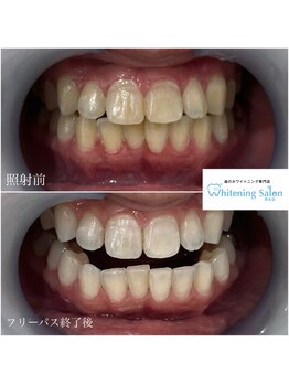 ホワイトニングサロン 熊本店/ホワイトニングで綺麗な歯