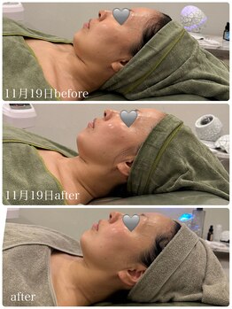 クラン 森ノ宮店(Clan)/REVIハーブピーリング