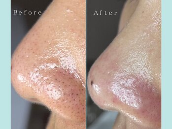 ティーツリー 名古屋 桜山(Tea Tree)/【毛穴ケア・毛穴洗浄】