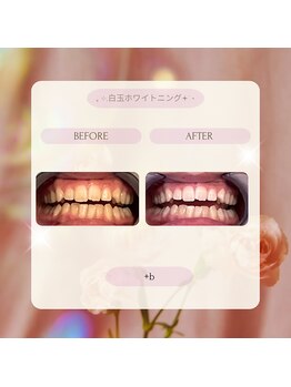 プラスビー 2号店(+b)/ホワイトニングビフォーアフター