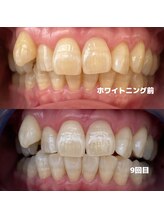 ホワイトニングビューティー 行橋店/苅田ホワイトニング