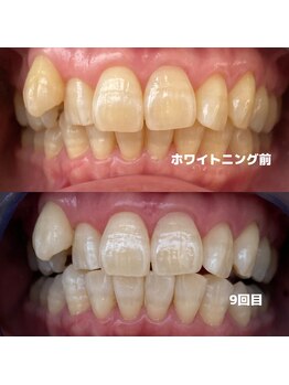 ホワイトニングビューティー 行橋店/苅田ホワイトニング